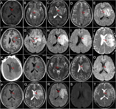 Case report: Cryptogenic giant brain abscess caused by Providencia rettgeri mimicking stroke and tumor in a patient with impaired immunity